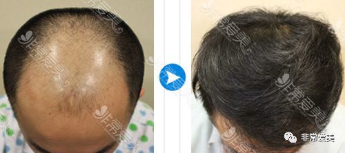 脱发最新突破揭秘，巷弄深处的秘密宝藏助力解决脱发问题